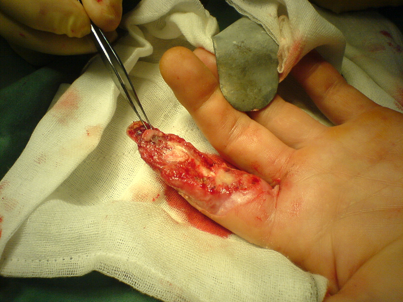 de-puplped finger injury
